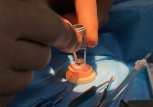 Амурские врачи впервые пересадили пациентам донорскую роговицу (видео)